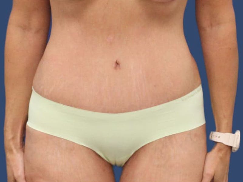 Tummy Tuck Before & After Gallery - Patient 55333017 - Image 2