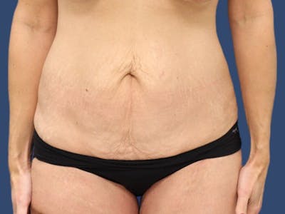 Tummy Tuck Before & After Gallery - Patient 55333017 - Image 1