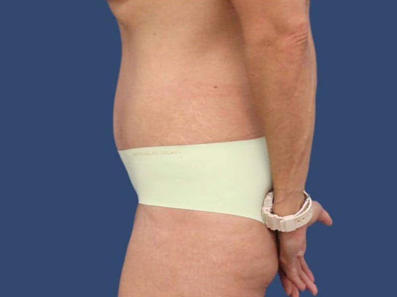 Tummy Tuck Before & After Gallery - Patient 55333017 - Image 4