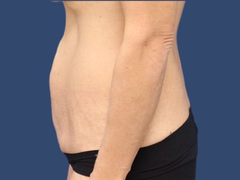 Tummy Tuck Gallery - Patient 55333017 - Image 3