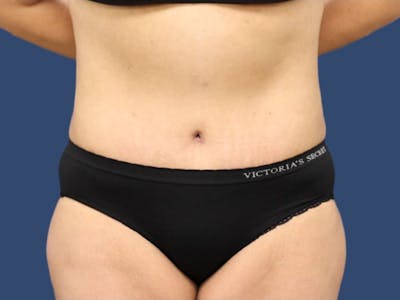 Tummy Tuck Before & After Gallery - Patient 55411062 - Image 2