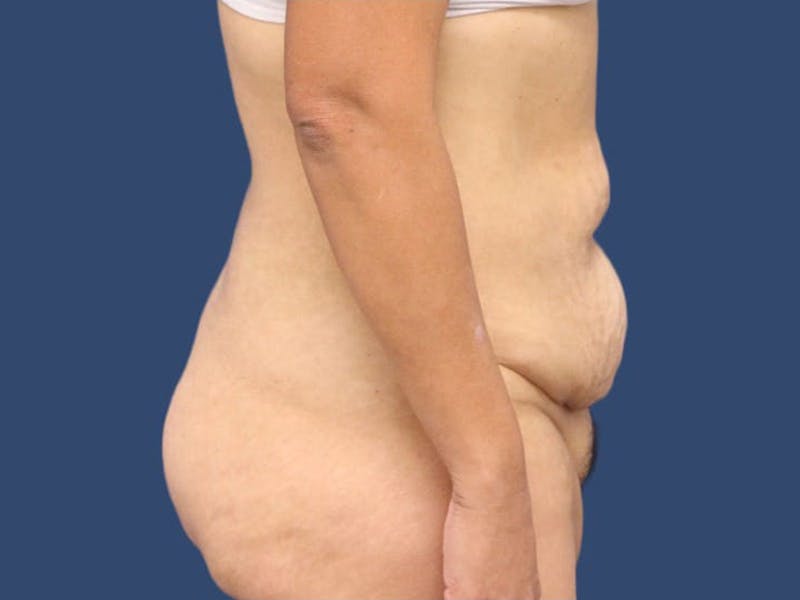 Tummy Tuck Before & After Gallery - Patient 55411062 - Image 3