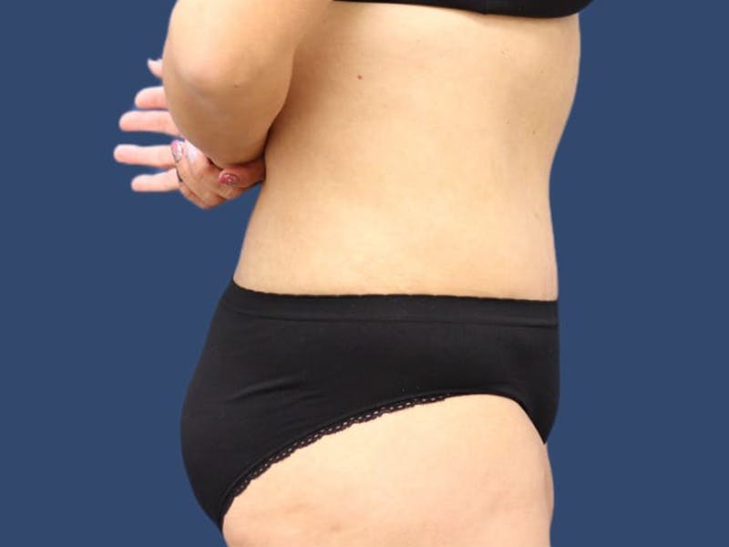 Tummy Tuck Before & After Gallery - Patient 55411062 - Image 4