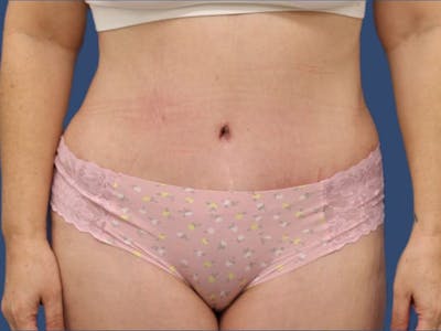 Tummy Tuck Before & After Gallery - Patient 55411128 - Image 2