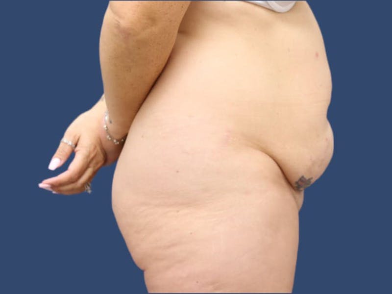 Tummy Tuck Before & After Gallery - Patient 55411128 - Image 3
