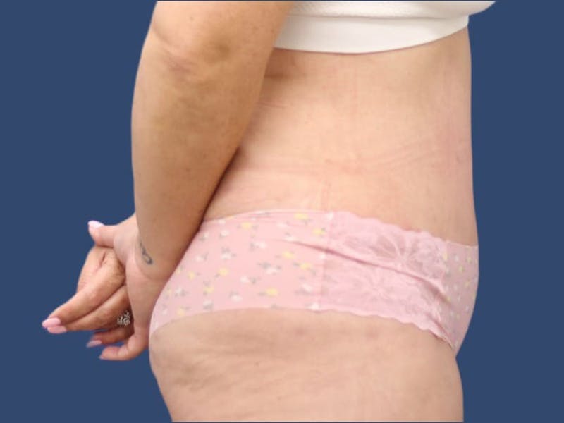 Tummy Tuck Before & After Gallery - Patient 55411128 - Image 4