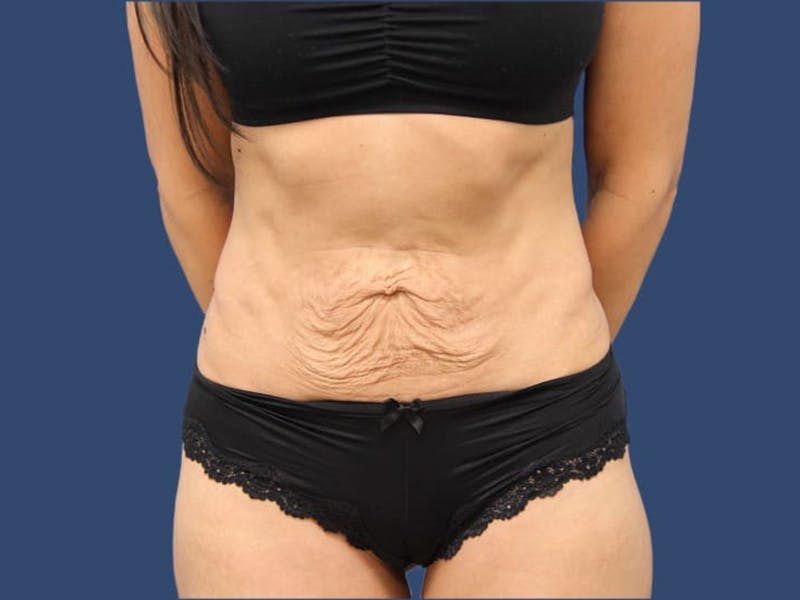 Tummy Tuck Gallery - Patient 55333015 - Image 1