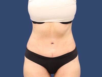 Tummy Tuck Before & After Gallery - Patient 55333015 - Image 2