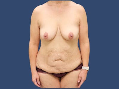 Mommy Makeover Before & After Gallery - Patient 55333002 - Image 1