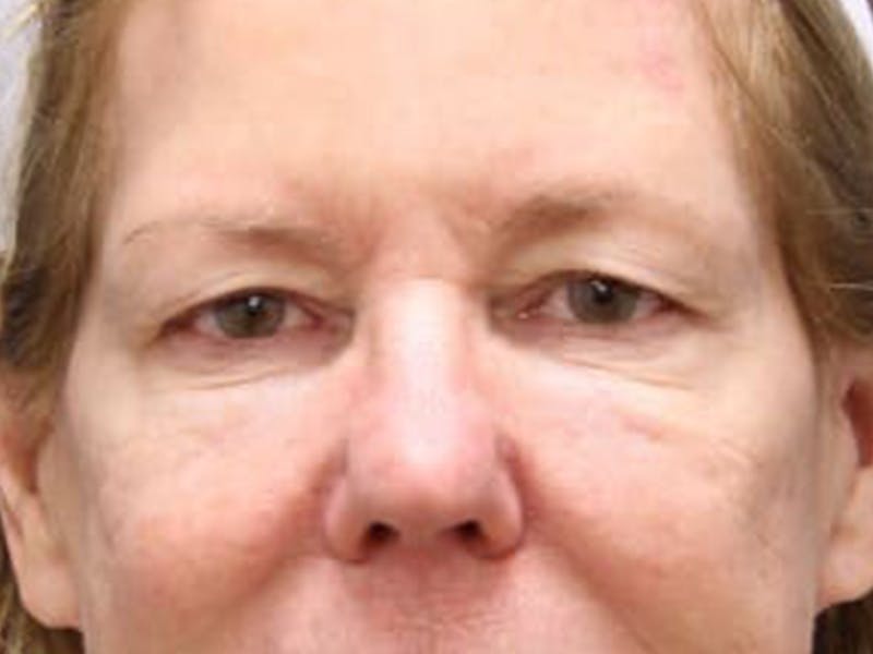 Eyelid Surgery Before & After Gallery - Patient 55332947 - Image 1