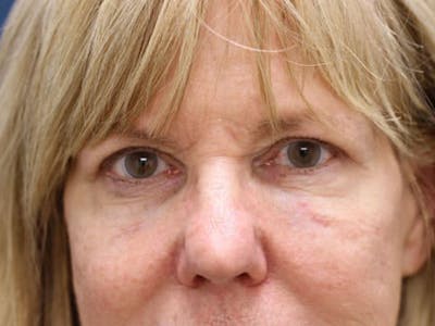 Eyelid Surgery Before & After Gallery - Patient 55332947 - Image 2