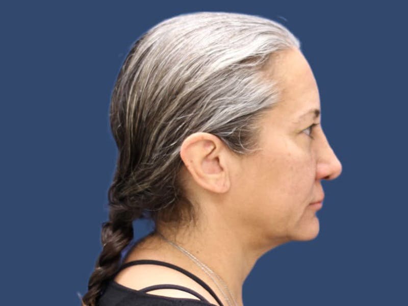 Facelift Before & After Gallery - Patient 55347900 - Image 3