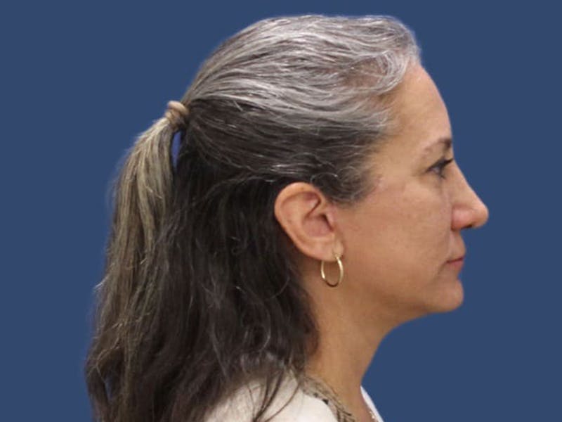 Facelift Before & After Gallery - Patient 55347900 - Image 4