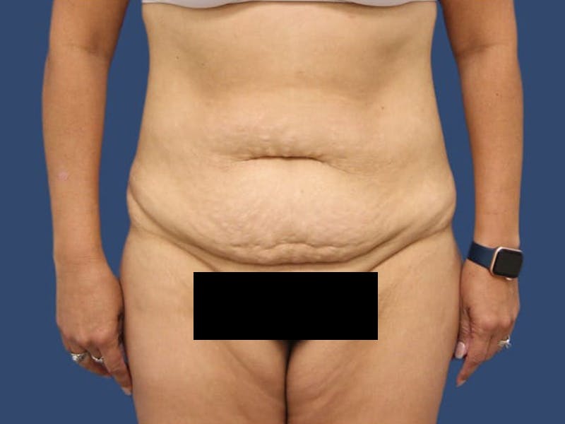 Tummy Tuck Gallery - Patient 55411062 - Image 1