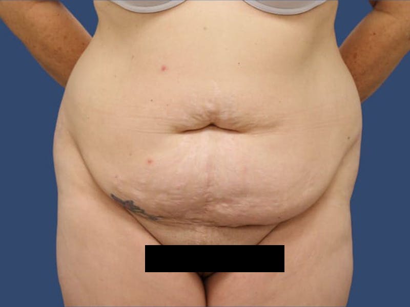 Tummy Tuck Gallery - Patient 55411128 - Image 1