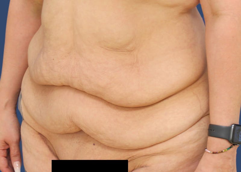Tummy Tuck Before & After Gallery - Patient 54882387 - Image 3