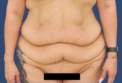 Tummy Tuck Before & After Gallery - Patient 54882387 - Image 1