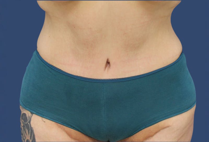 Tummy Tuck Before & After Gallery - Patient 54882387 - Image 2
