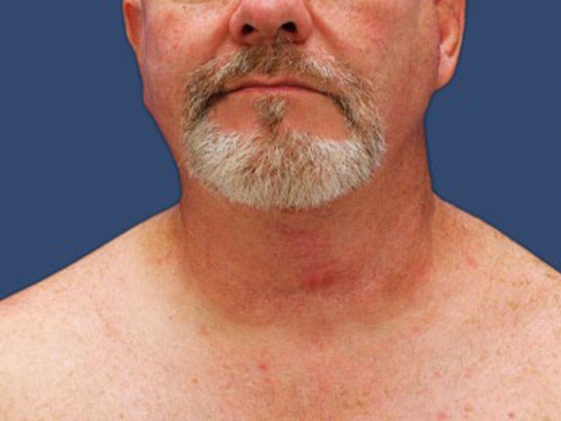 Neck Lift Before & After Gallery - Patient 55506010 - Image 2