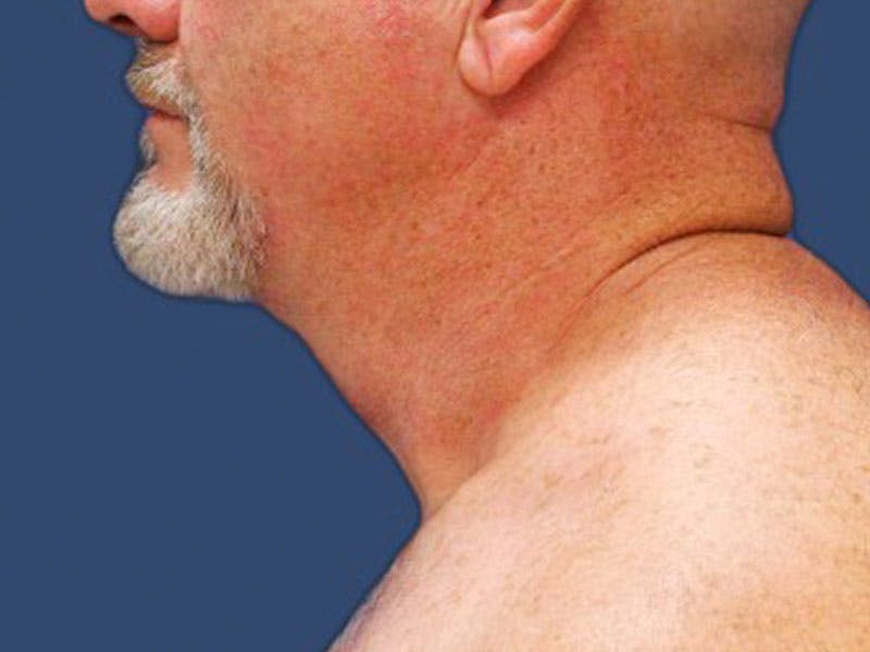 Neck Lift Before & After Gallery - Patient 55506010 - Image 4