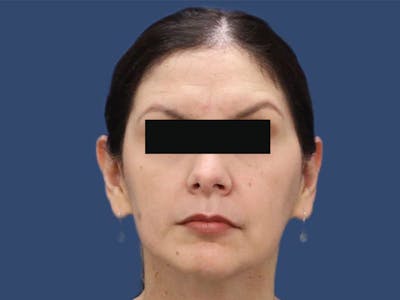 Fat Grafting Before & After Gallery - Patient 55332963 - Image 2