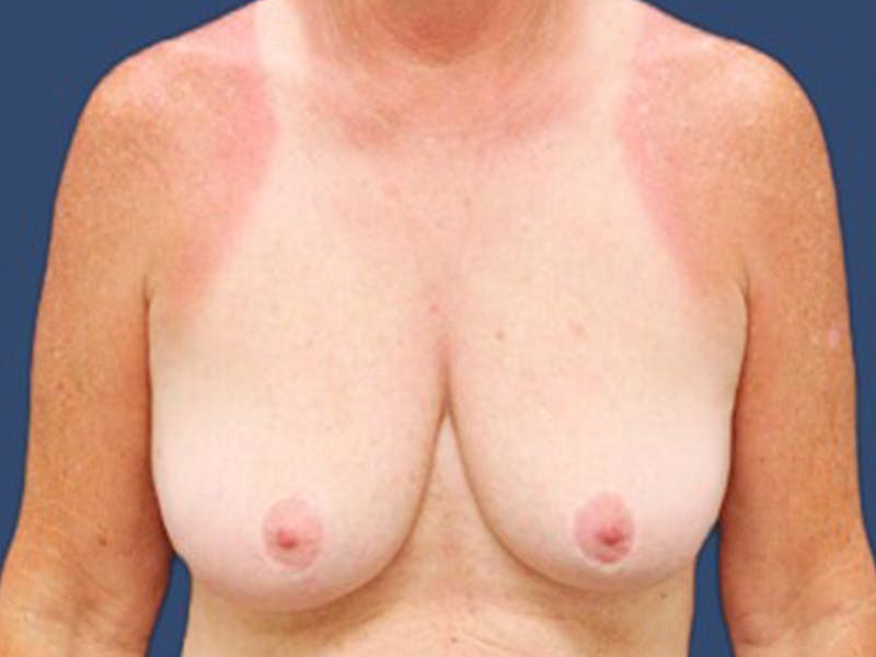 Breast Revision Before & After Gallery - Patient 368754 - Image 1