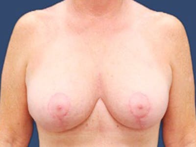 Breast Revision Before & After Gallery - Patient 368754 - Image 2