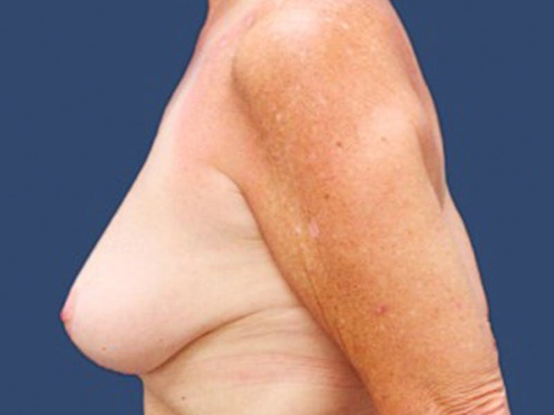 Breast Lift with Augmentation Before & After Gallery - Patient 55978068 - Image 3