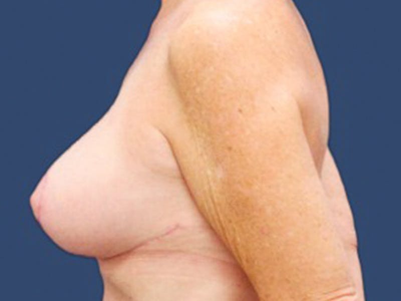 Breast Lift with Augmentation Before & After Gallery - Patient 55978068 - Image 4