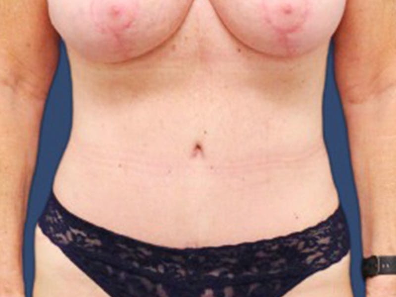 Tummy Tuck Before & After Gallery - Patient 55978066 - Image 2