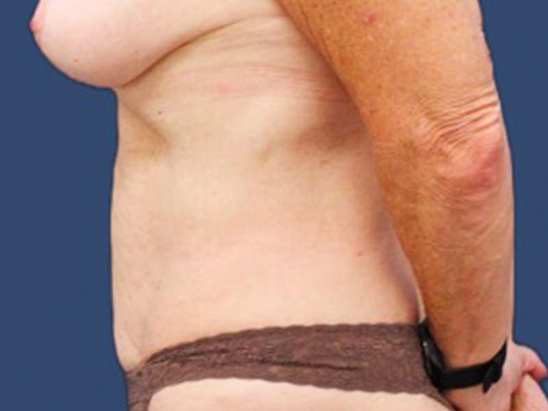 Tummy Tuck Before & After Gallery - Patient 55978066 - Image 3