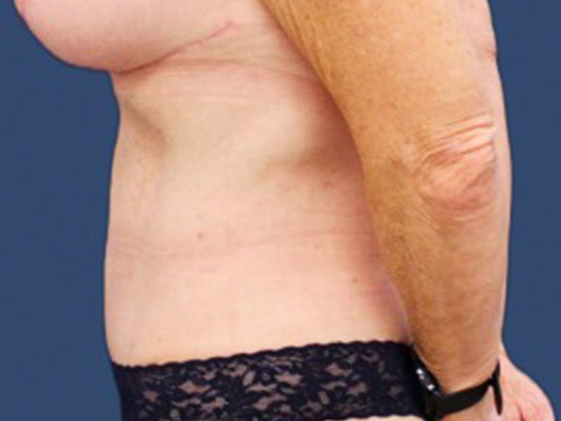 Tummy Tuck Before & After Gallery - Patient 55978066 - Image 4