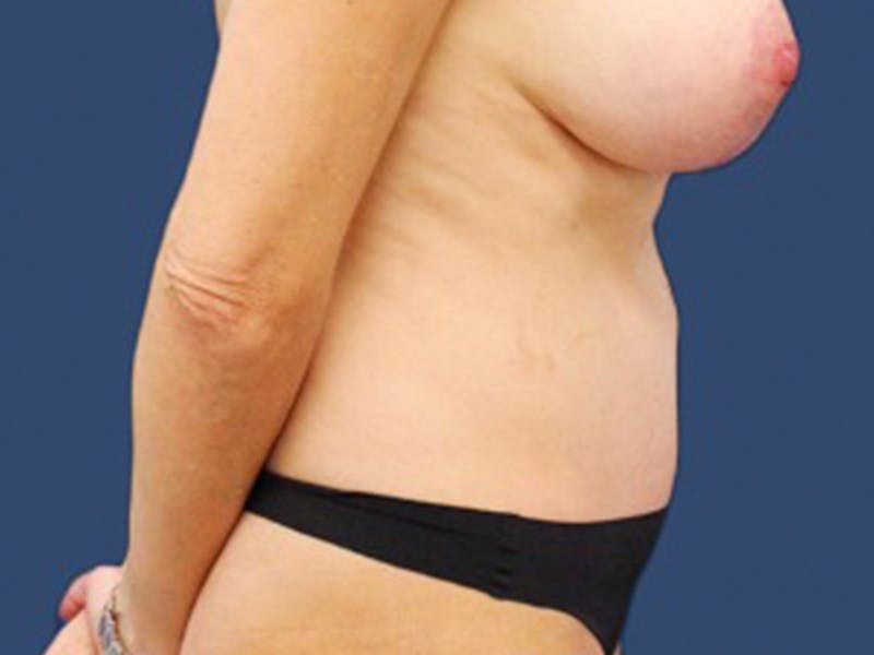 Tummy Tuck Before & After Gallery - Patient 55978071 - Image 4