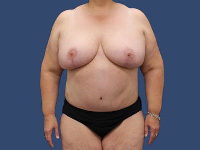 Mommy Makeover Before & After Gallery - Patient 56927498 - Image 2