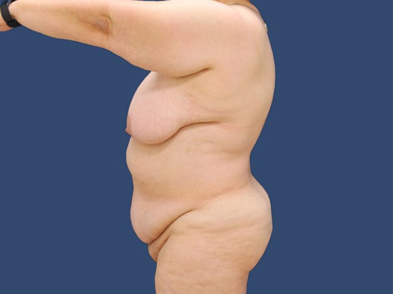 Tummy Tuck Before & After Gallery - Patient 56927499 - Image 3