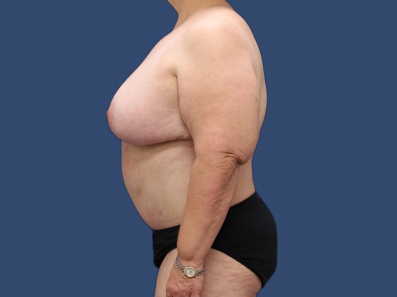 Tummy Tuck Before & After Gallery - Patient 56927499 - Image 4