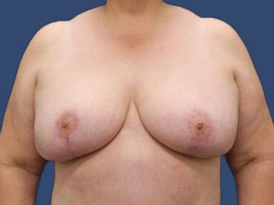 Breast Reduction Before & After Gallery - Patient 56927500 - Image 2