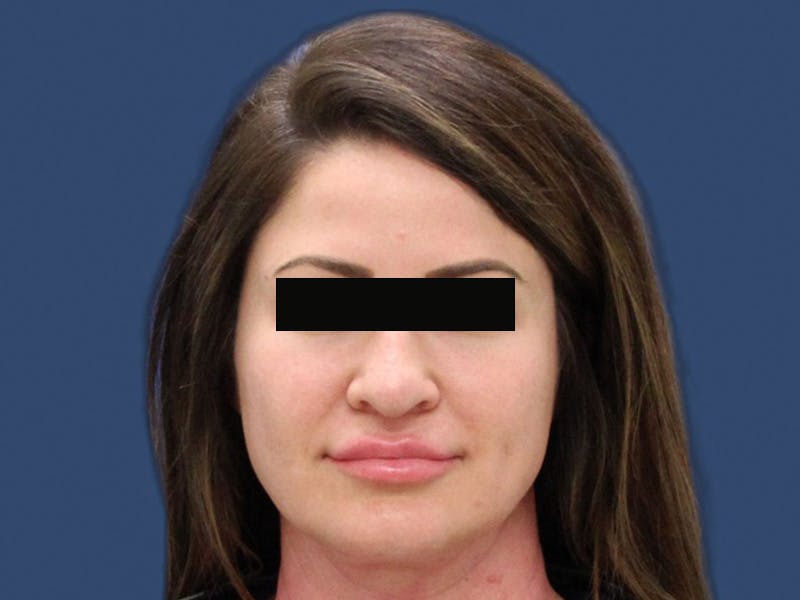 Rhinoplasty Before & After Gallery - Patient 63226502 - Image 1