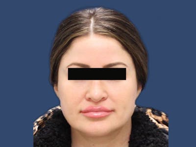 Rhinoplasty Before & After Gallery - Patient 63226502 - Image 2