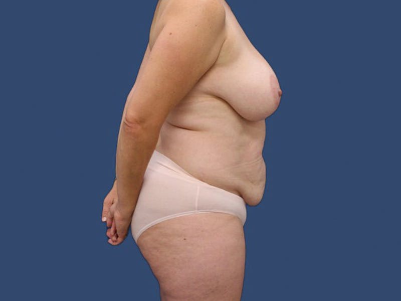 Tummy Tuck Before & After Gallery - Patient 63910159 - Image 3