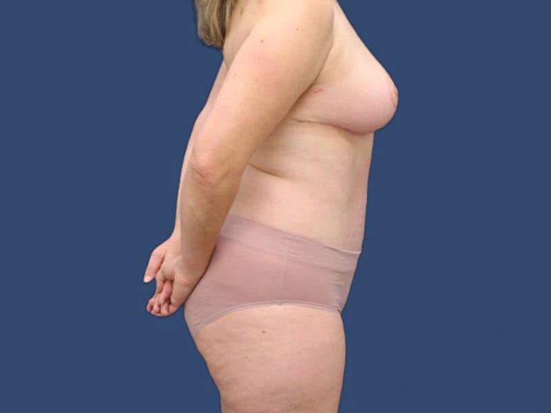 Breast Reduction Before & After Gallery - Patient 63910160 - Image 4