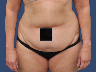 Tummy Tuck Before & After Gallery - Patient 64012076 - Image 1