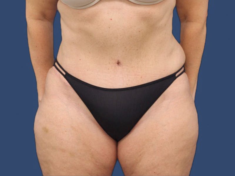 Tummy Tuck Before & After Gallery - Patient 64012076 - Image 2