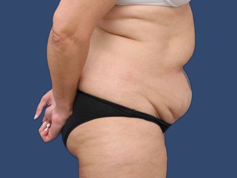 Tummy Tuck Before & After Gallery - Patient 64012076 - Image 3