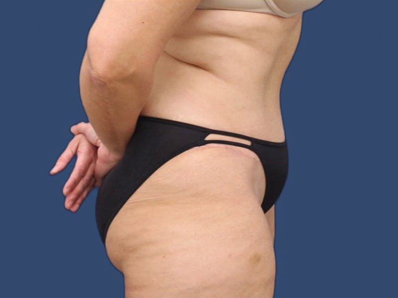 Tummy Tuck Before & After Gallery - Patient 64012076 - Image 4