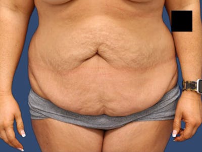Tummy Tuck Before & After Gallery - Patient 64012078 - Image 1