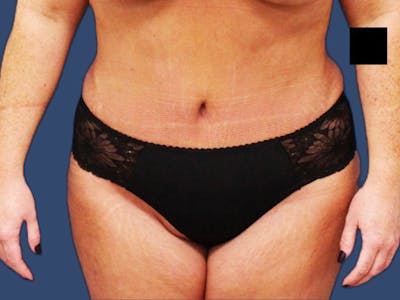 Tummy Tuck Before & After Gallery - Patient 64012078 - Image 2
