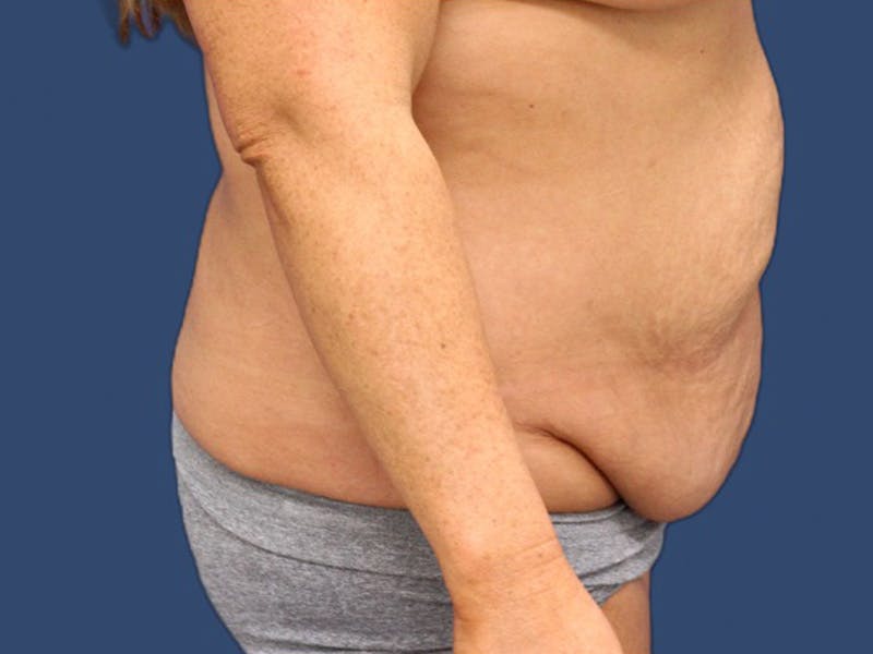 Tummy Tuck Before & After Gallery - Patient 64012078 - Image 3