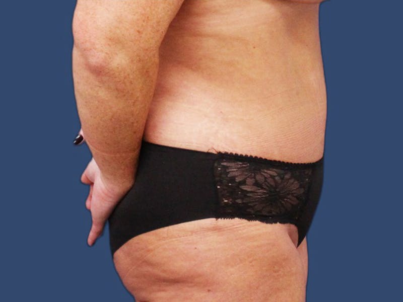 Tummy Tuck Before & After Gallery - Patient 64012078 - Image 4