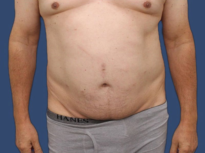 Abdominoplasty Before & After Gallery - Patient 64072870 - Image 1